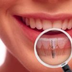 Implanturi dentare care au revolutionat lumea stomatologiei!